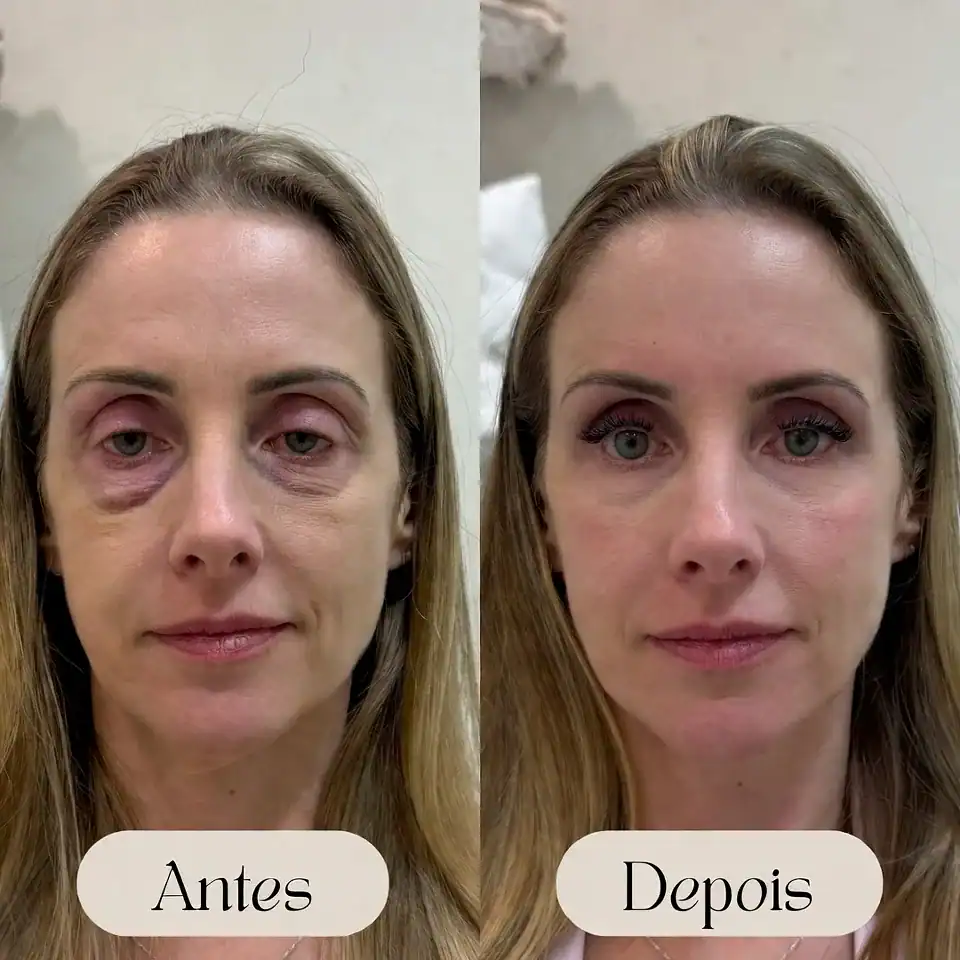 Blefaroplastia antes e depois: o que muda de verdade e quando o resultado aparece