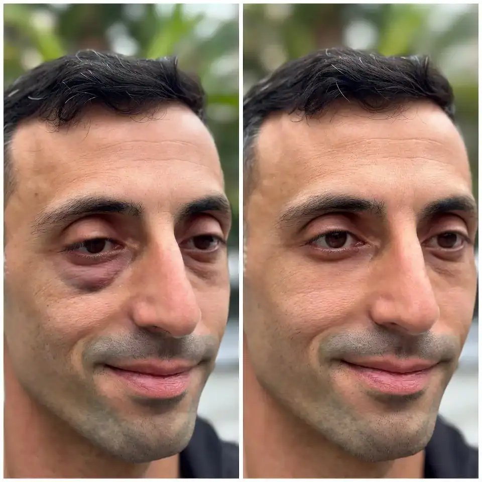 blefaroplastia 02