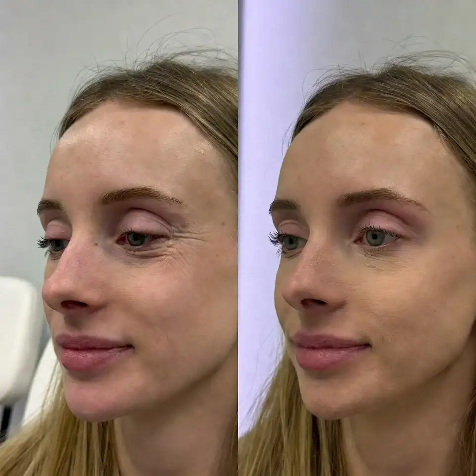 blefaroplastia 03